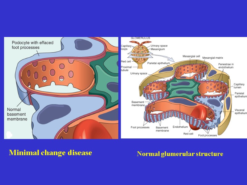 Minimal change disease Normal glumerular structure